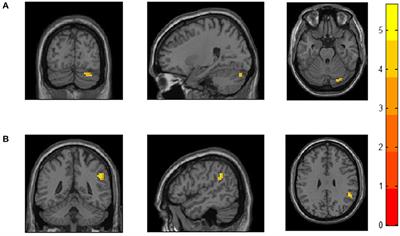 Enhanced Functional Connectivity Within Executive Function Network in Remitted or Partially Remitted MDD Patients